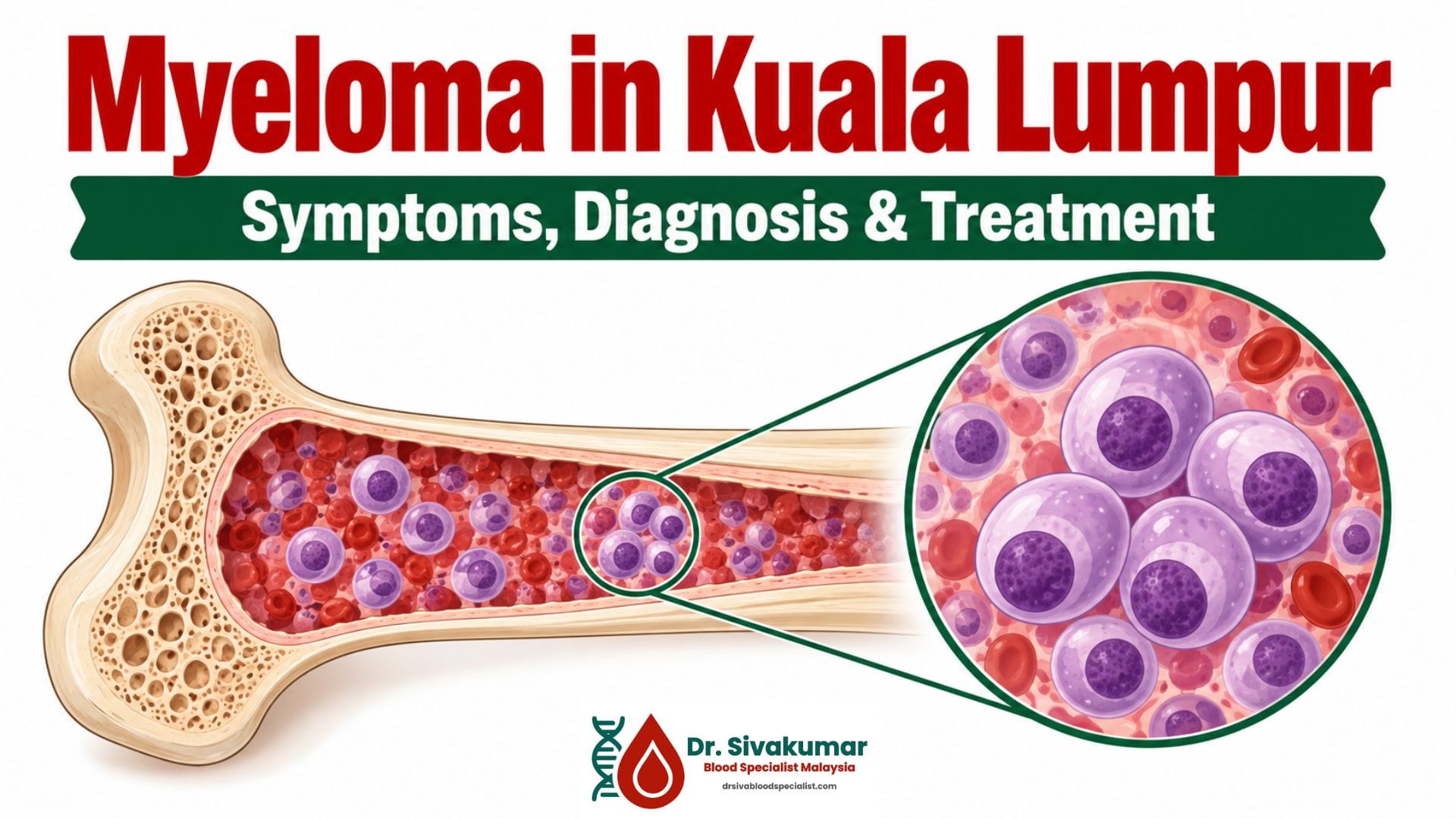 Myeloma in Kuala Lumpur
